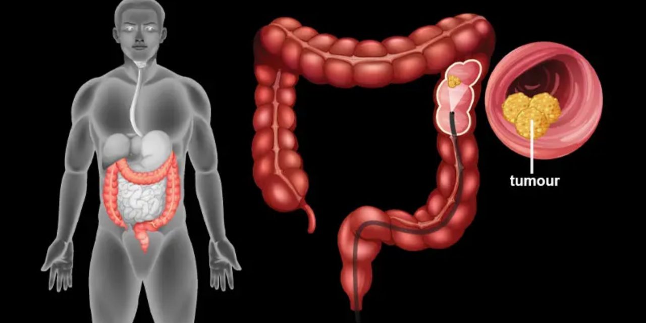 Kanker Usus dan Pendampingan Herbal – Konsultasi Kesehatan Non Medis