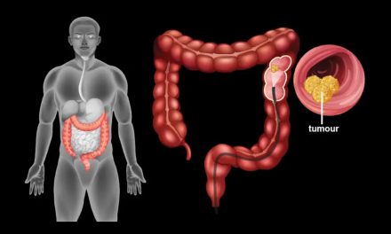 Kanker Usus dan Pendampingan Herbal – Konsultasi Kesehatan Non Medis